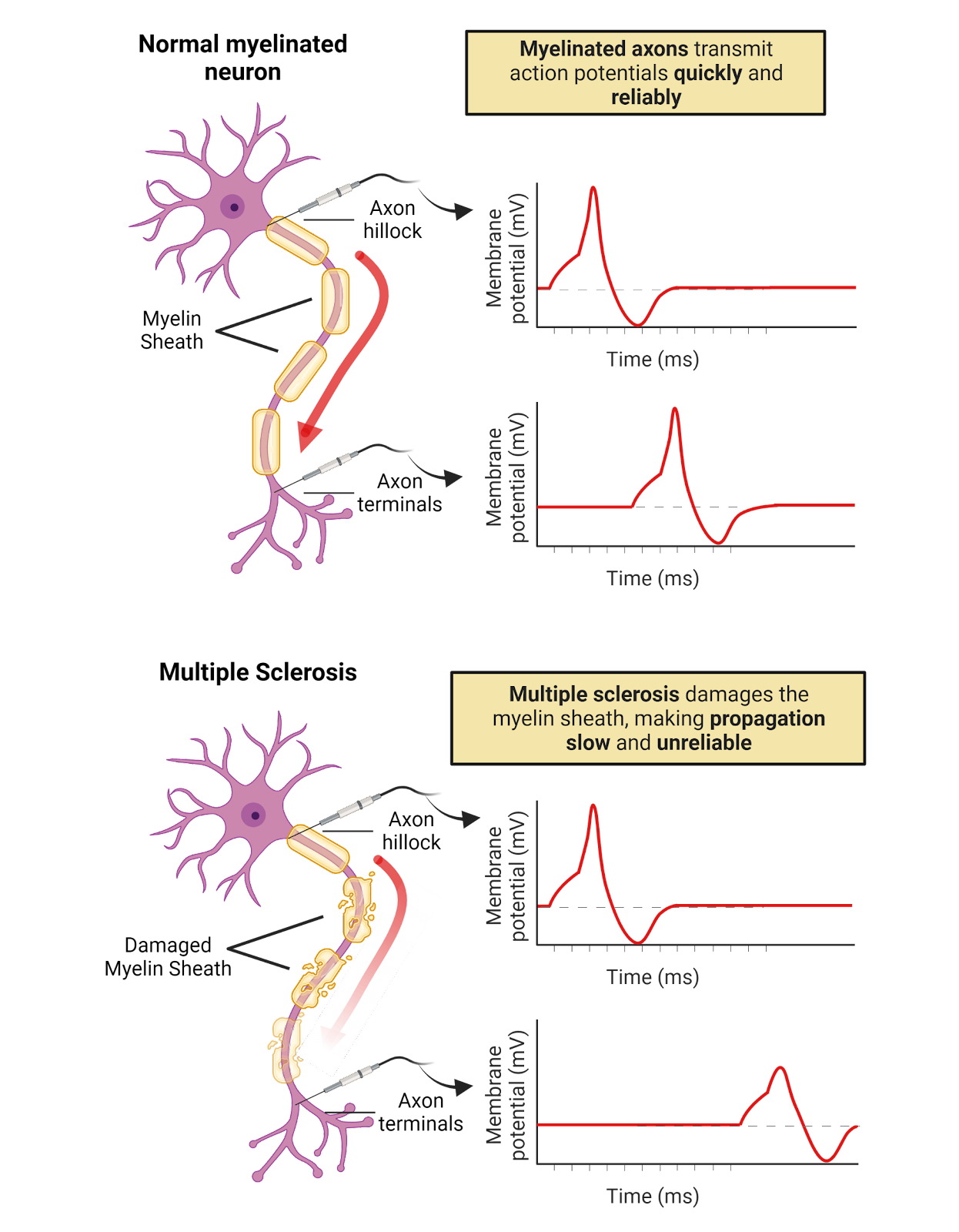 Multiple sclerosis.